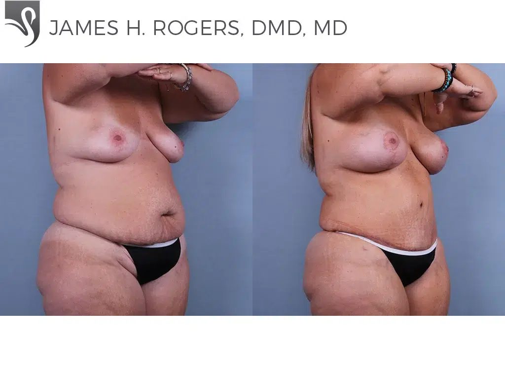Before and After Image: Abdominoplasty (Tummy Tuck) Case #74114 - right-front-oblique
