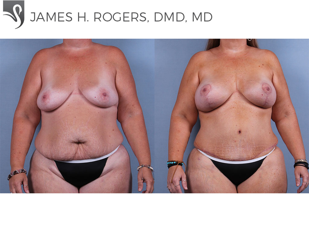 Before and After Image: Breast Lift (Mastopexy) Case #74114 - front