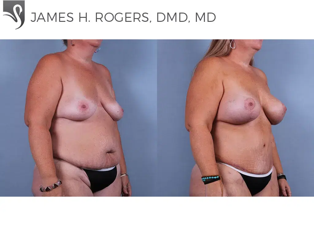 Before and After Image: Breast Lift (Mastopexy) Case #74114 - right-front-oblique