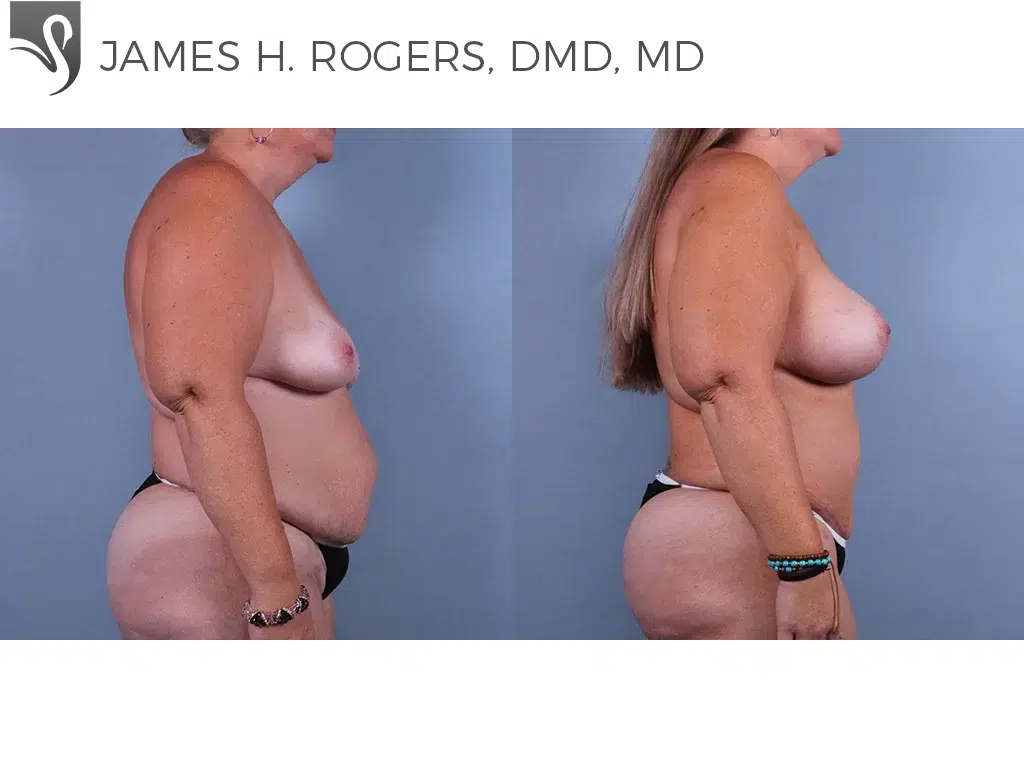 Before and After Image: Breast Lift (Mastopexy) Case #74114 - right-side