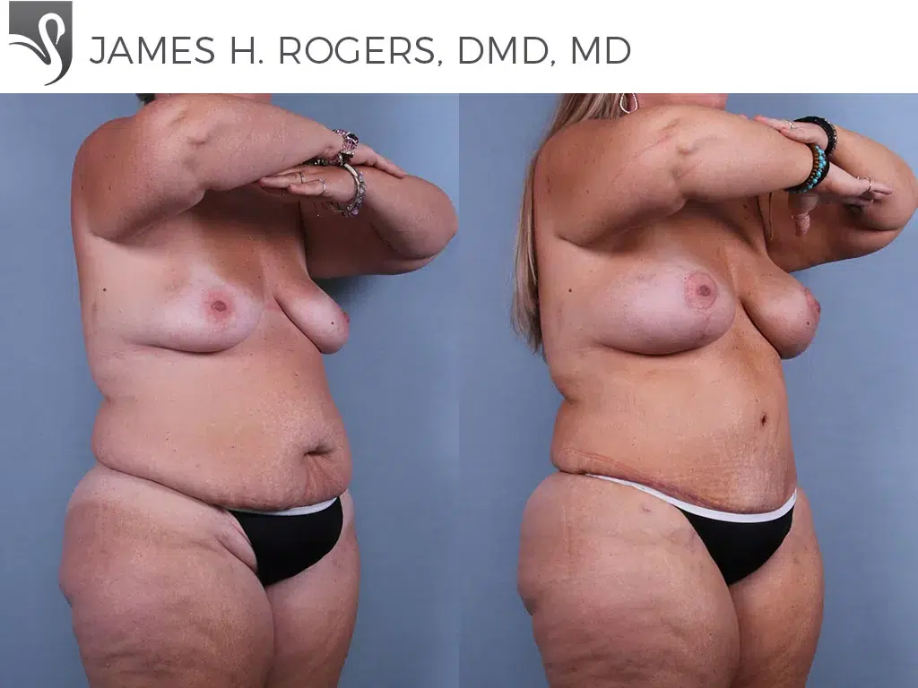 Before and After Image: Mommy Makeover Case #74114 - right-front-oblique