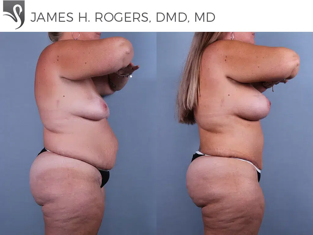 Before and After Image: Mommy Makeover Case #74114 - right-side