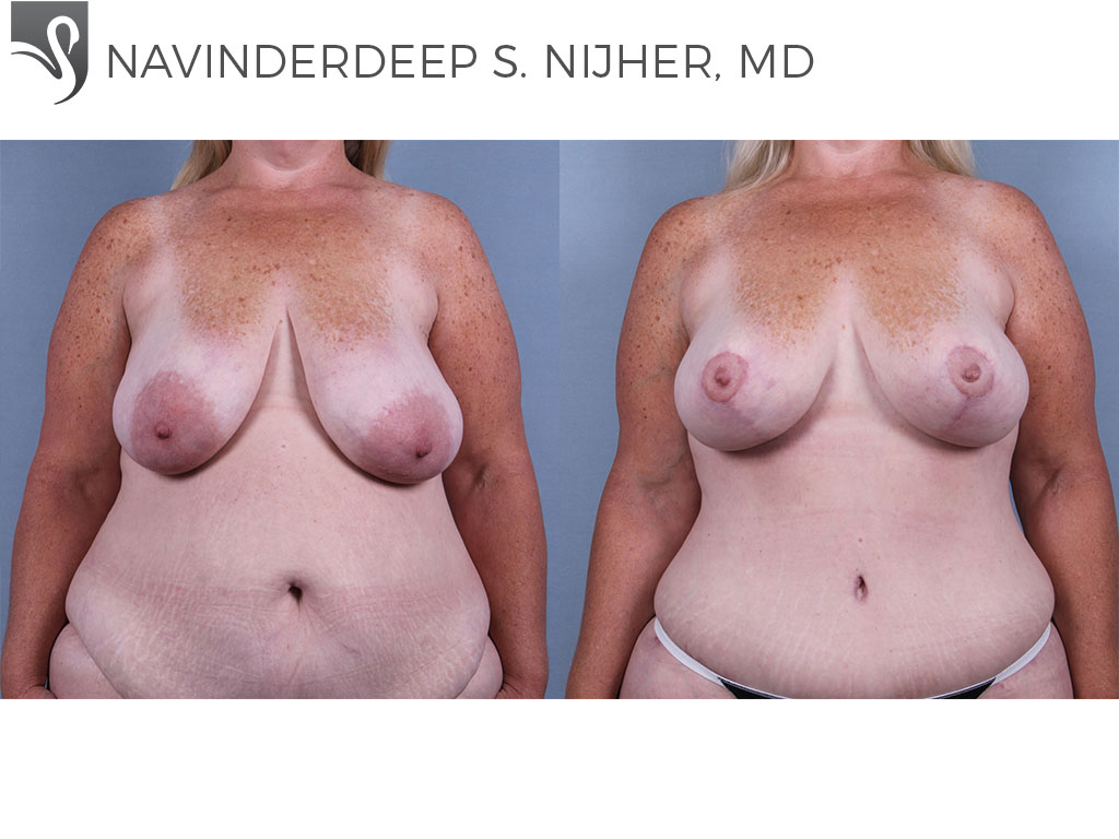 Before and After Image: Breast Lift (Mastopexy) Case #74132