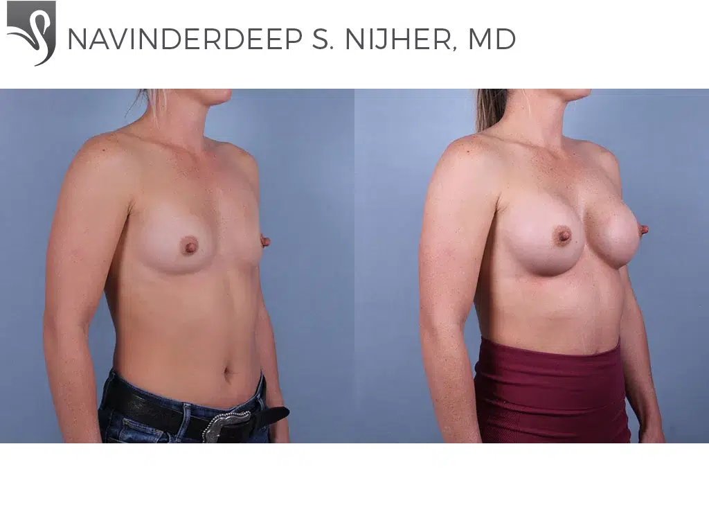 Before and After Image: Breast Augmentation Case #74398 - right-front-oblique