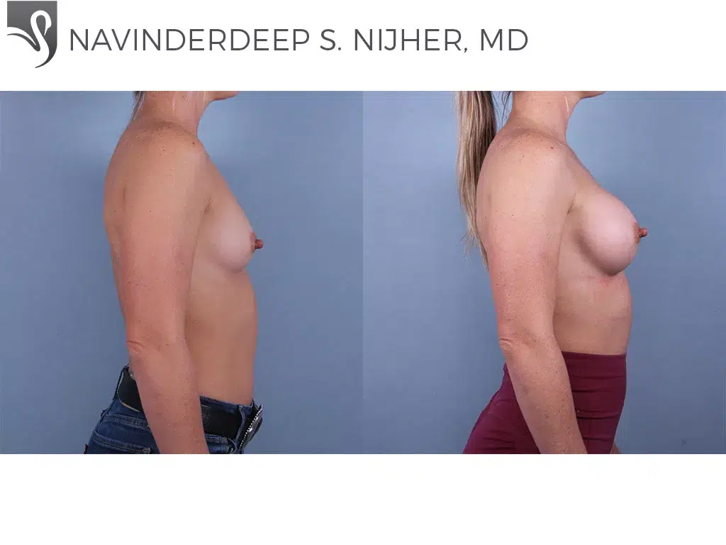 Before and After Image: Breast Augmentation Case #74398 - right-side