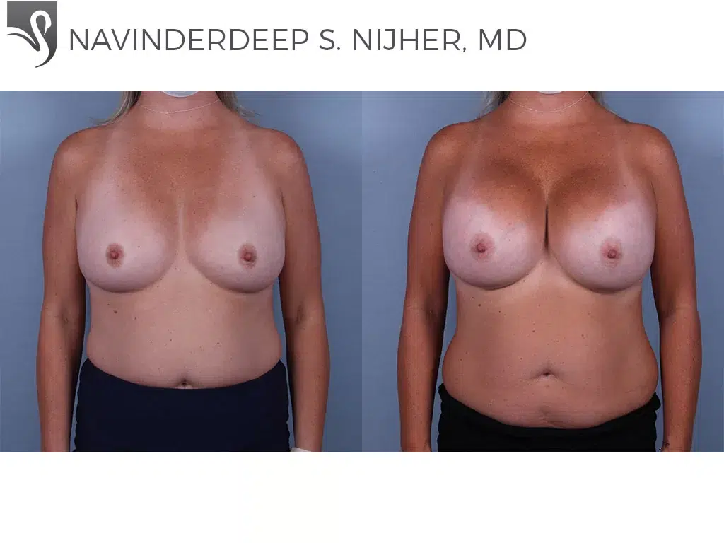 Before and After Image: Breast Augmentation Case #74521 - front