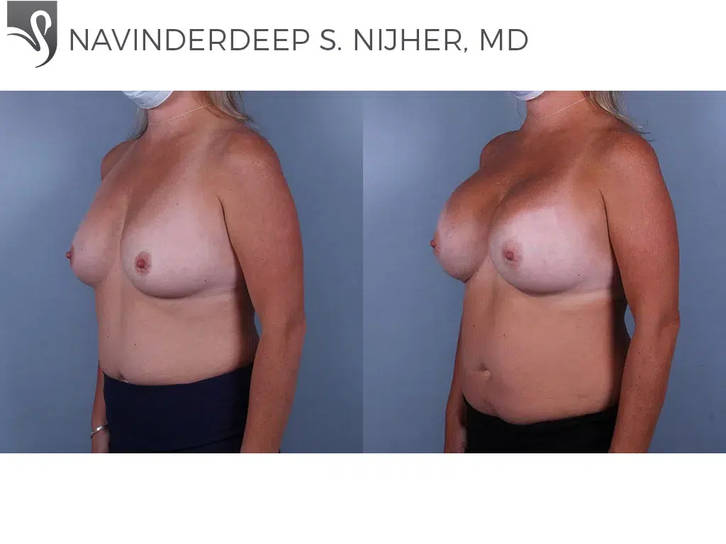 Before and After Image: Breast Augmentation Case #74521 - left-front-oblique
