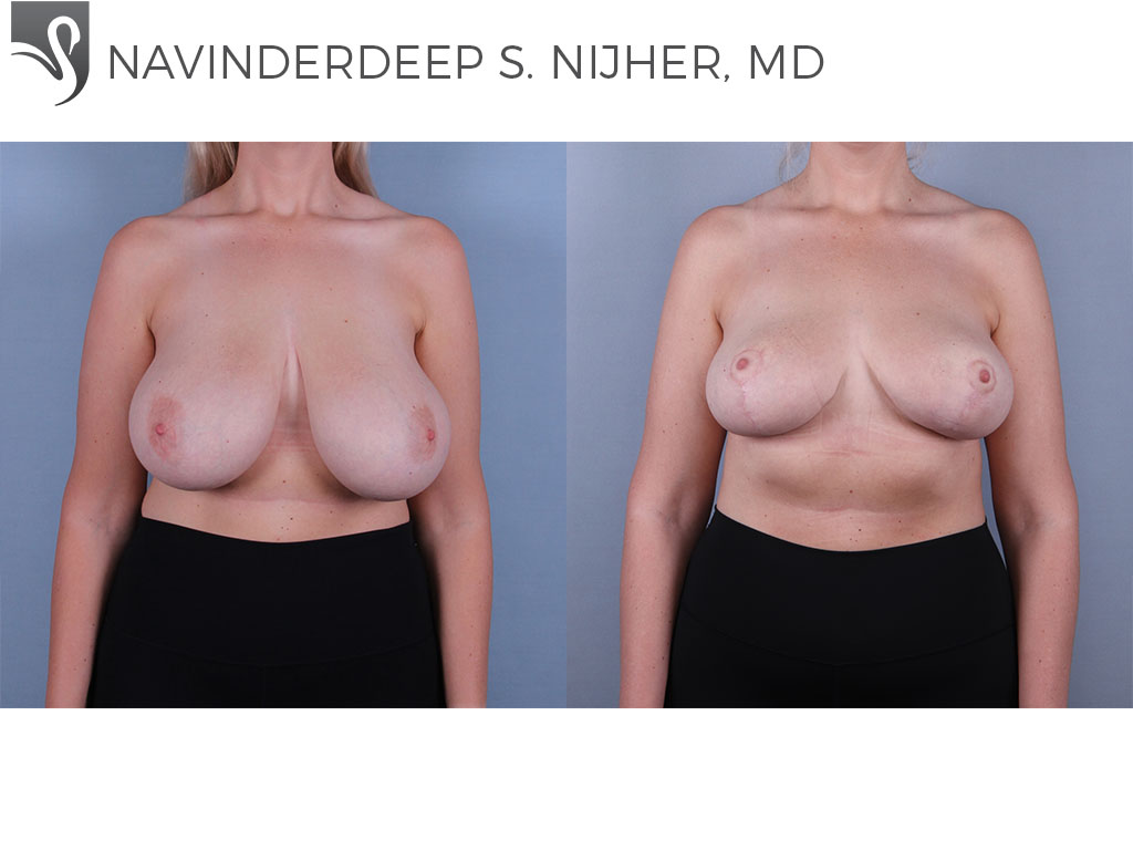 Before and After Image: Breast Lift (Mastopexy) Case #74755