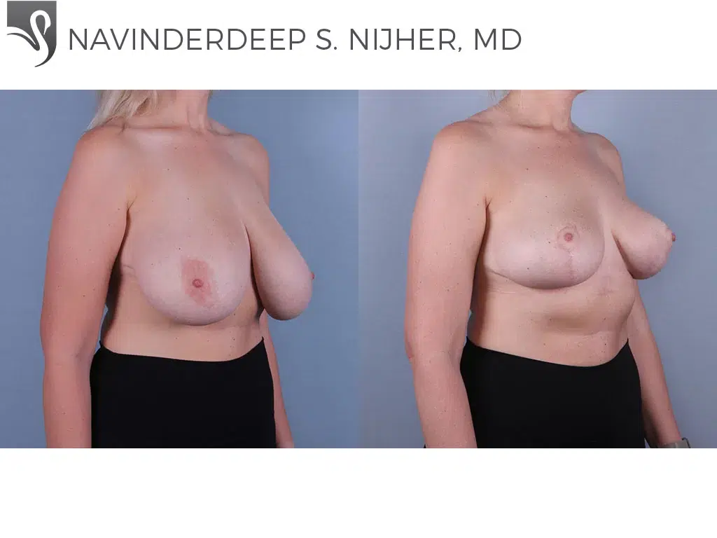 Before and After Image: Breast Lift (Mastopexy) Case #74755 - right-front-oblique