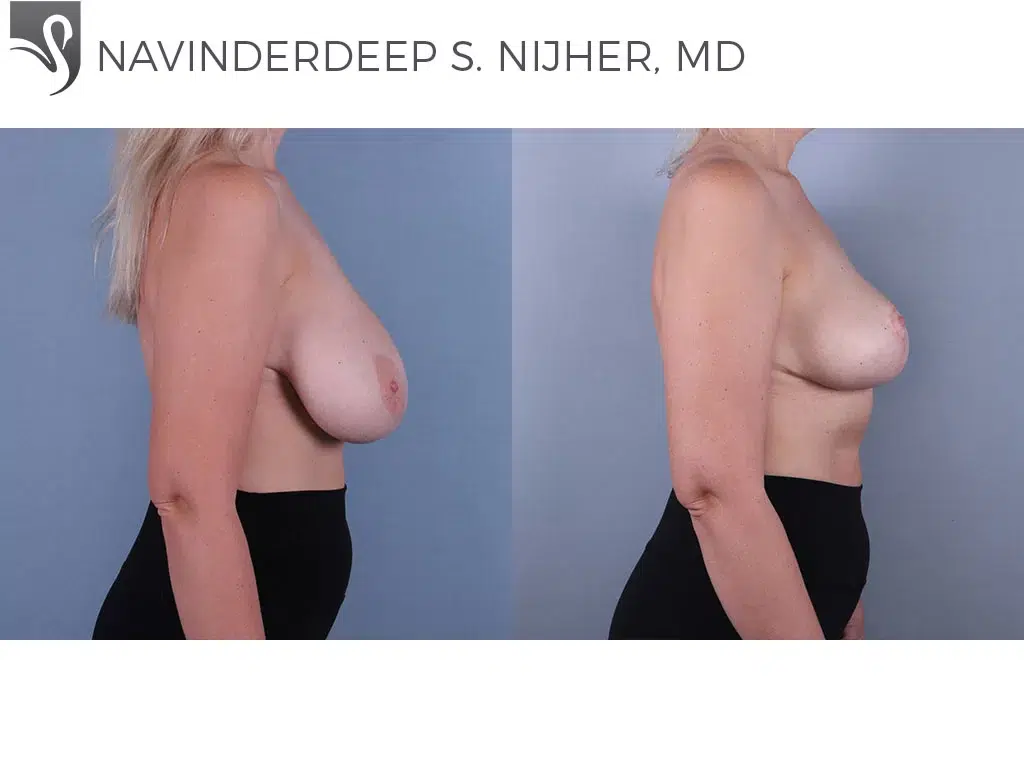 Before and After Image: Female Breast Reduction Case #74755 - right-side