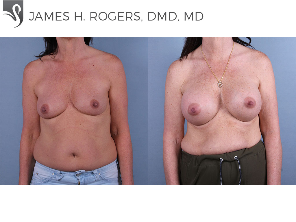 Before and After Image: Breast Augmentation Case #74853 - front