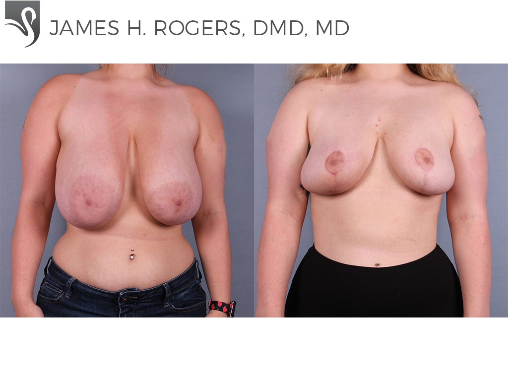Before and After Image: Female Breast Reduction Case #74910