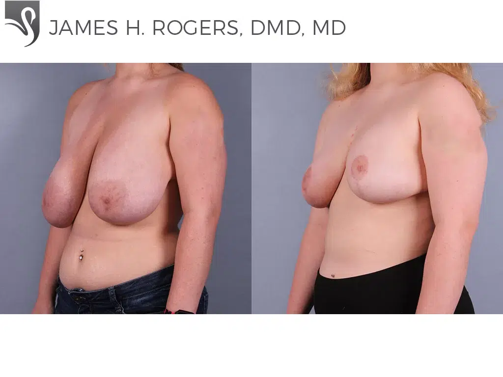 Before and After Image: Female Breast Reduction Case #74910 - left-front-oblique