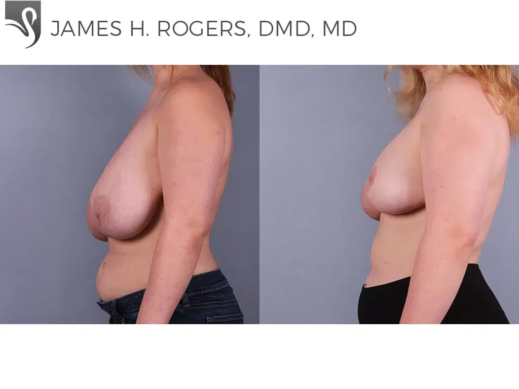 Before and After Image: Female Breast Reduction Case #74910 - left-side