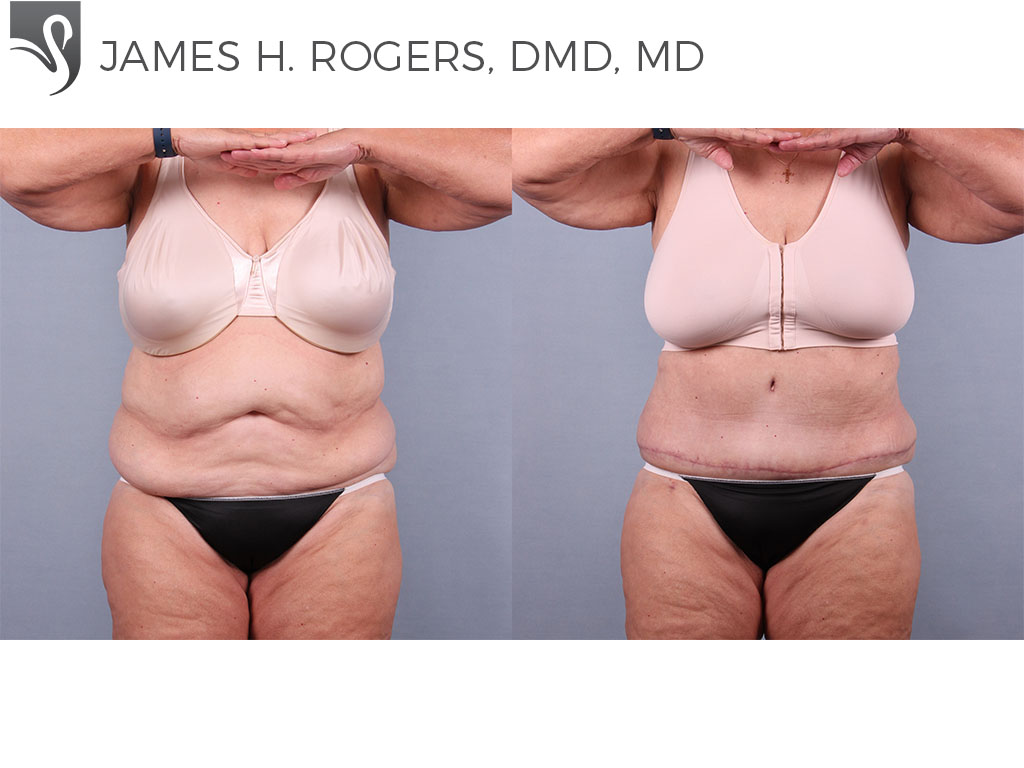 Before and After Image: Abdominoplasty (Tummy Tuck) Case #75556 - front