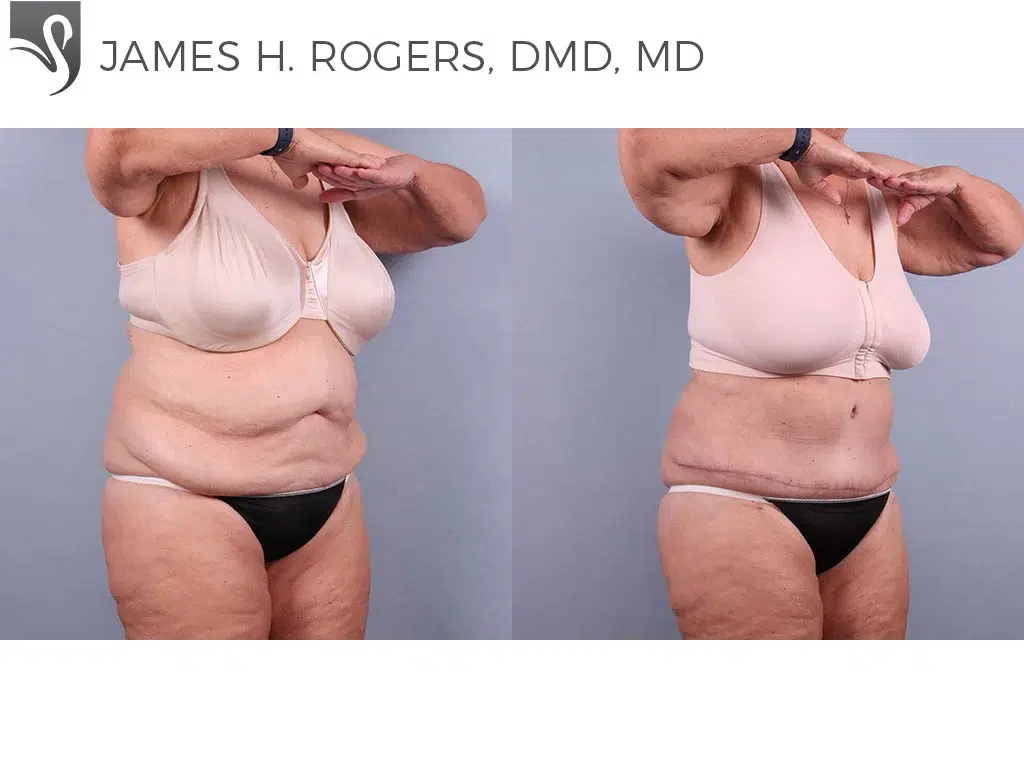 Before and After Image: Abdominoplasty (Tummy Tuck) Case #75556 - right-front-oblique