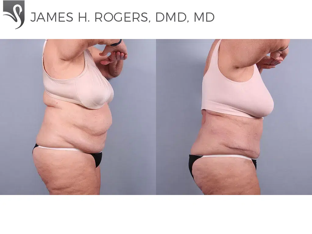 Before and After Image: Abdominoplasty (Tummy Tuck) Case #75556 - right-side