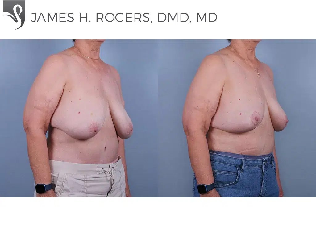 Before and After Image: Female Breast Reduction Case #75556 - right-front-oblique