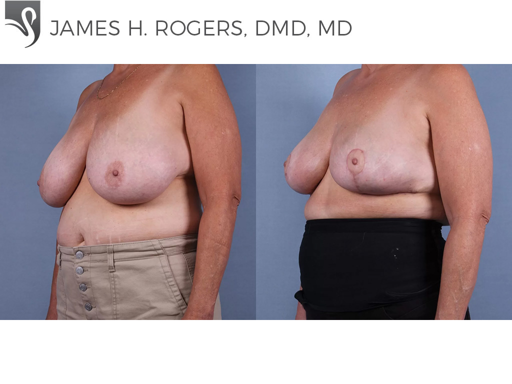 Before and After Image: Female Breast Reduction Case #75739 - left-front-oblique