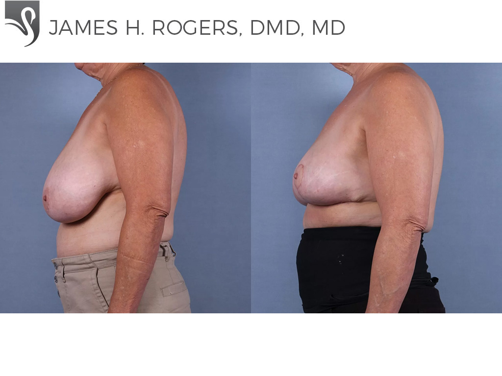Before and After Image: Female Breast Reduction Case #75739 - left-side