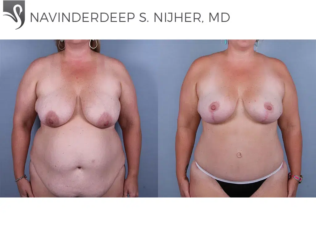 Before and After Image: Breast Lift (Mastopexy) Case #76444