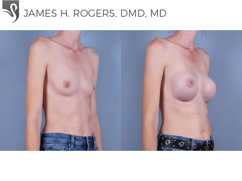 Before and After Image: Breast Augmentation Case #76647 - right-front-oblique