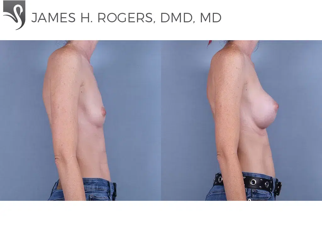 Before and After Image: Breast Augmentation Case #76647 - right-side