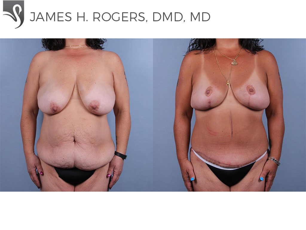 Before and After Image: Breast Lift (Mastopexy) Case #76929