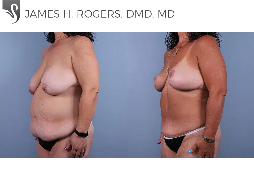 Before and After Image: Breast Lift (Mastopexy) Case #76929 - left-front-oblique