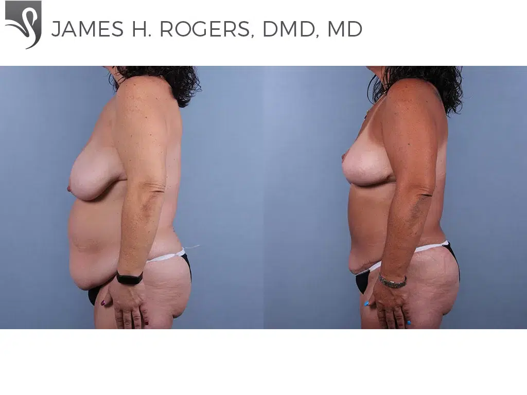 Before and After Image: Breast Lift (Mastopexy) Case #76929 - left-side