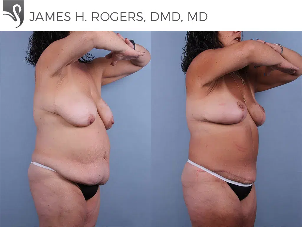 Before and After Image: Mommy Makeover Case #76929 - right-front-oblique