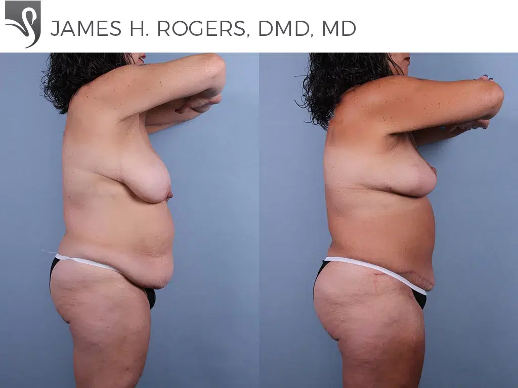 Before and After Image: Mommy Makeover Case #76929 - right-side