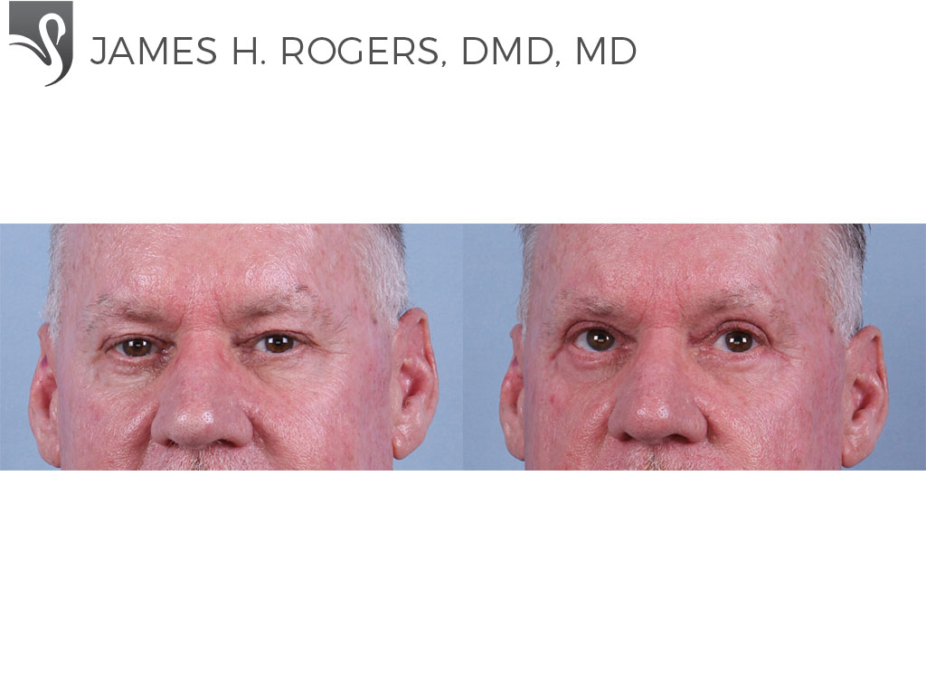 Before and After Image: Eyelid Surgery Case #76949