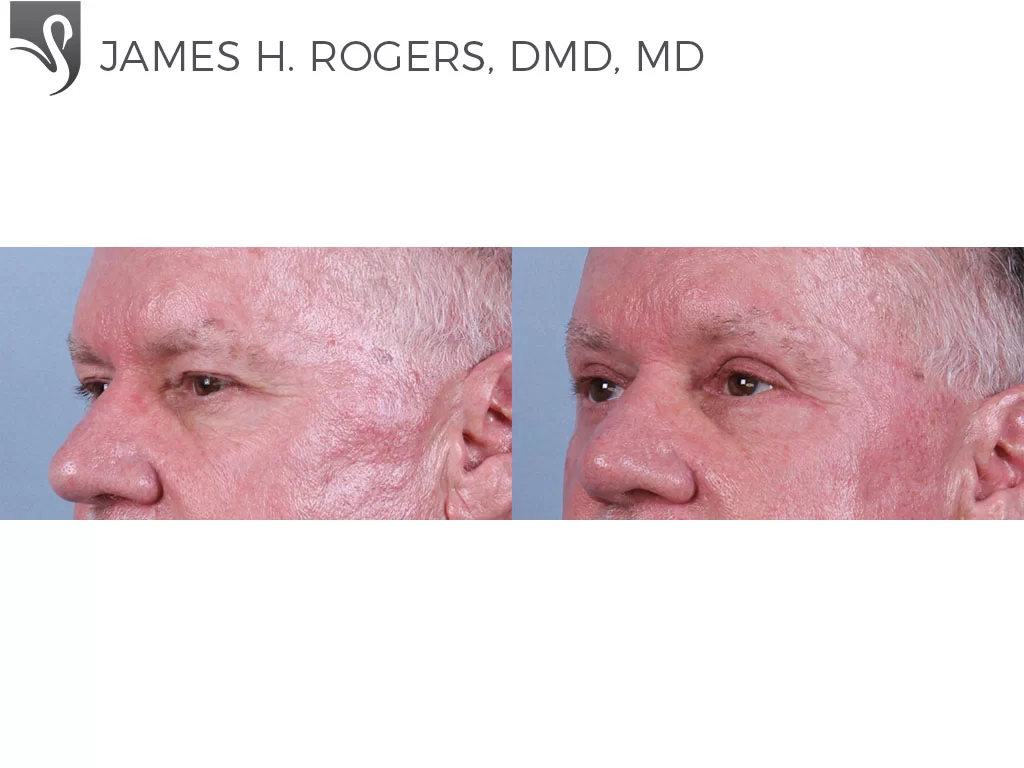 Before and After Image: Eyelid Surgery Case #76949 - left-front-oblique