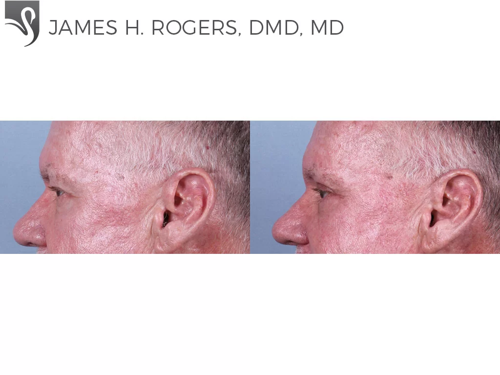 Before and After Image: Eyelid Surgery Case #76949 - left-side