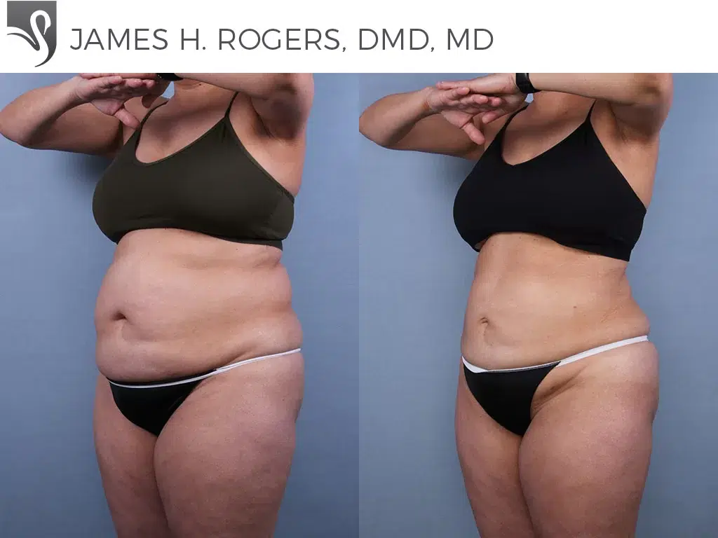 Before and After Image: Liposuction Case #77252 - left-front-oblique