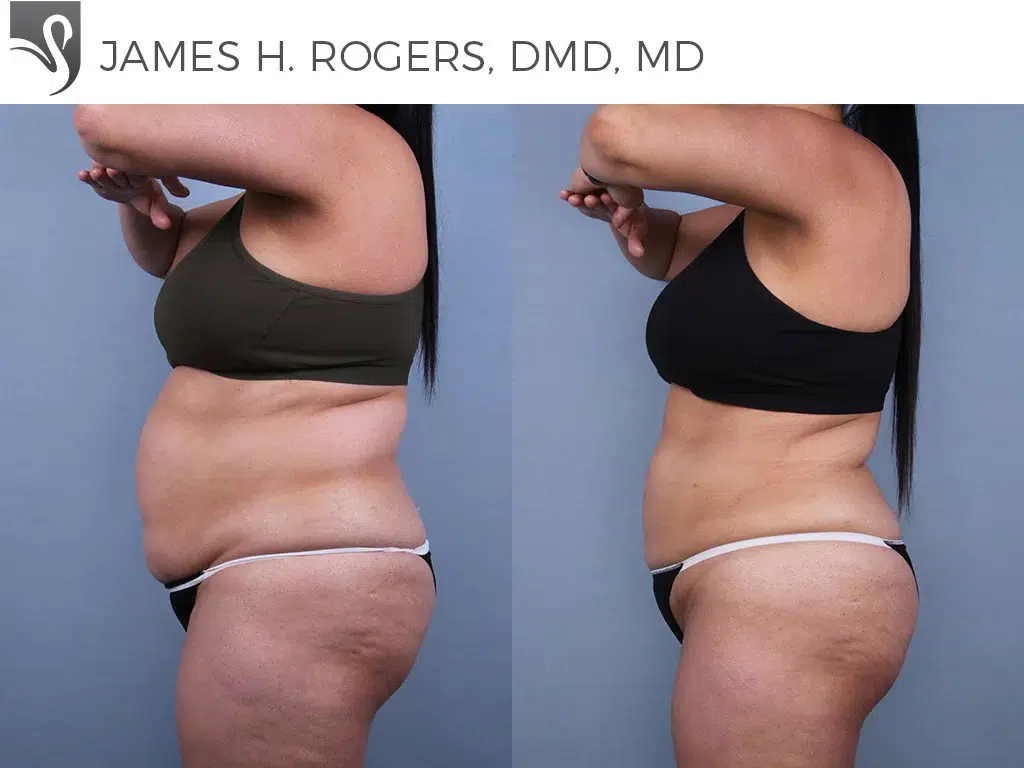 Before and After Image: Liposuction Case #77252 - left-side