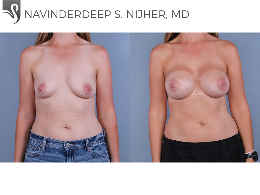 Before and After Image: Breast Augmentation Case #77338