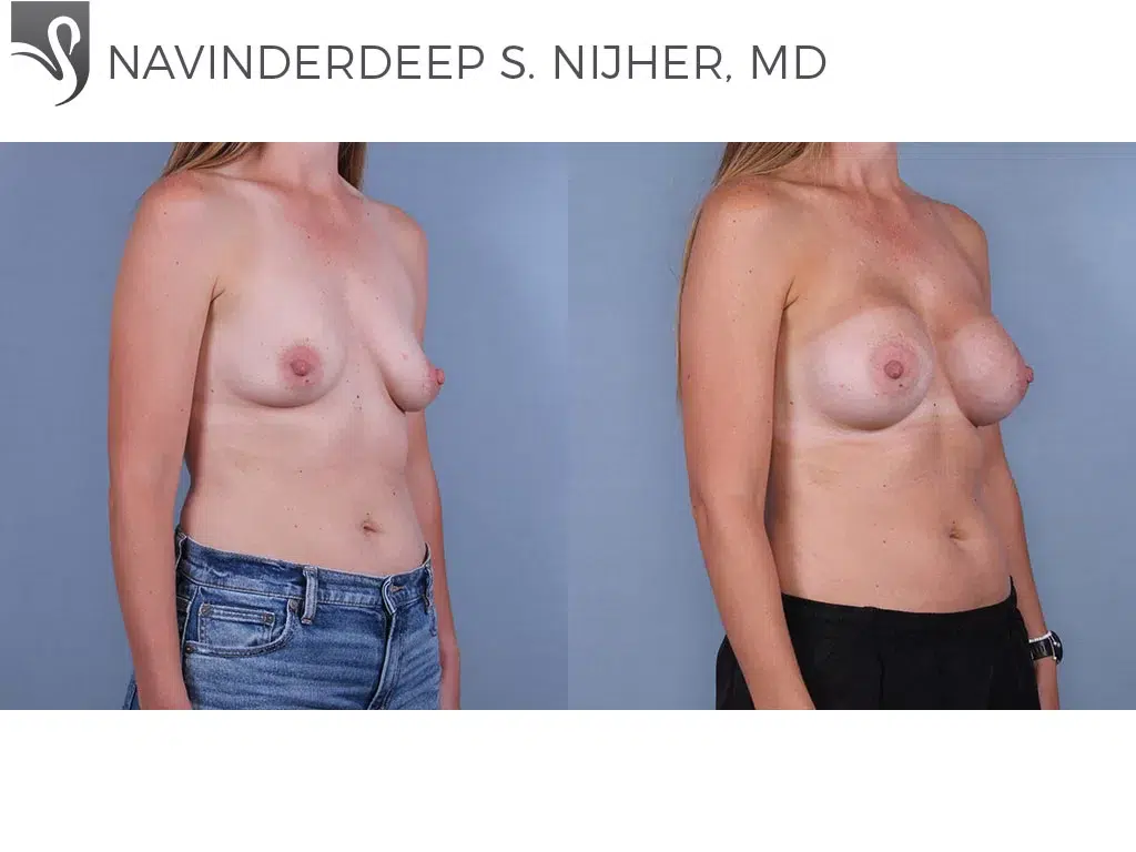 Before and After Image: Breast Augmentation Case #77338 - right-front-oblique