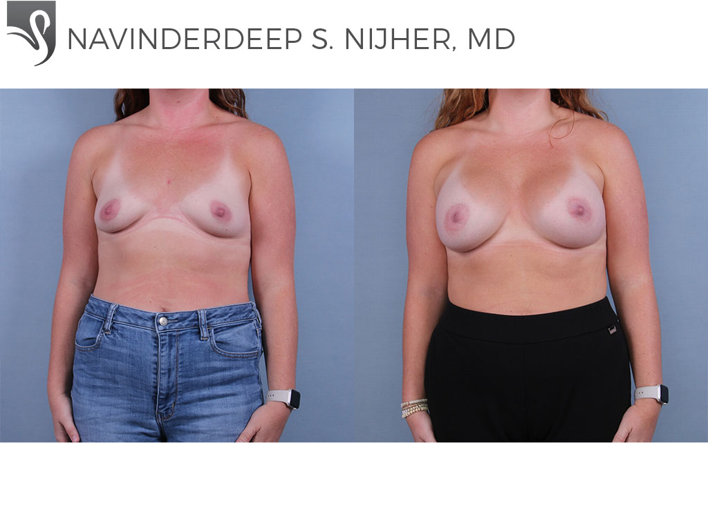 Before and After Image: Breast Augmentation Case #77611 - front