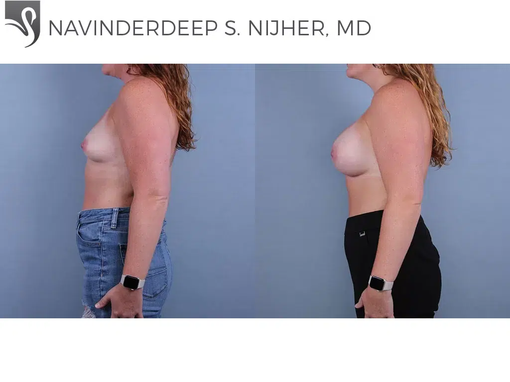 Before and After Image: Breast Augmentation Case #77611 - left-side