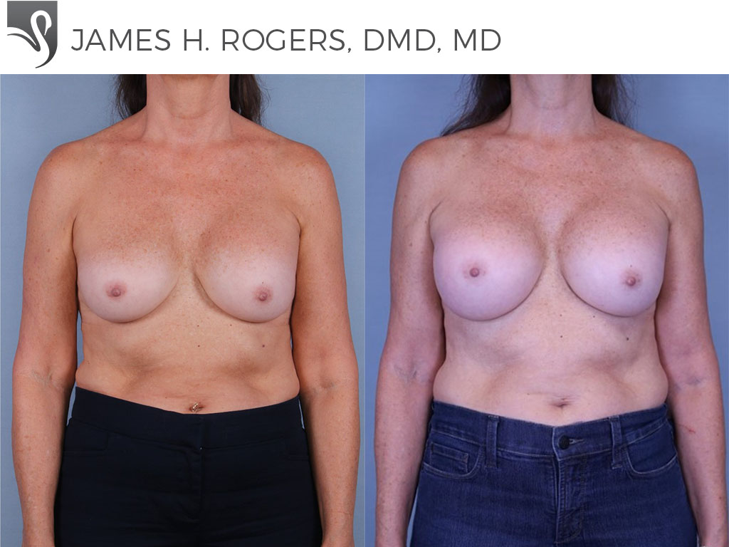 Before and After Image: Breast Revisions Case #78339