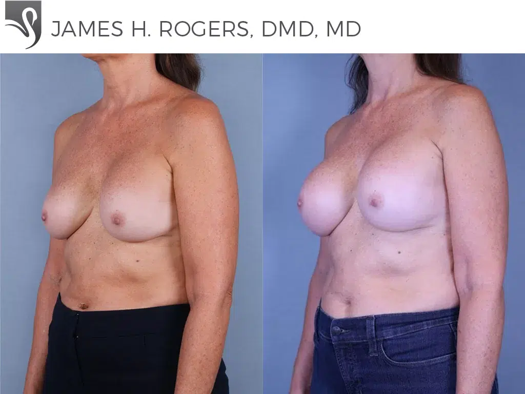 Before and After Image: Breast Revisions Case #78339 - left-front-oblique