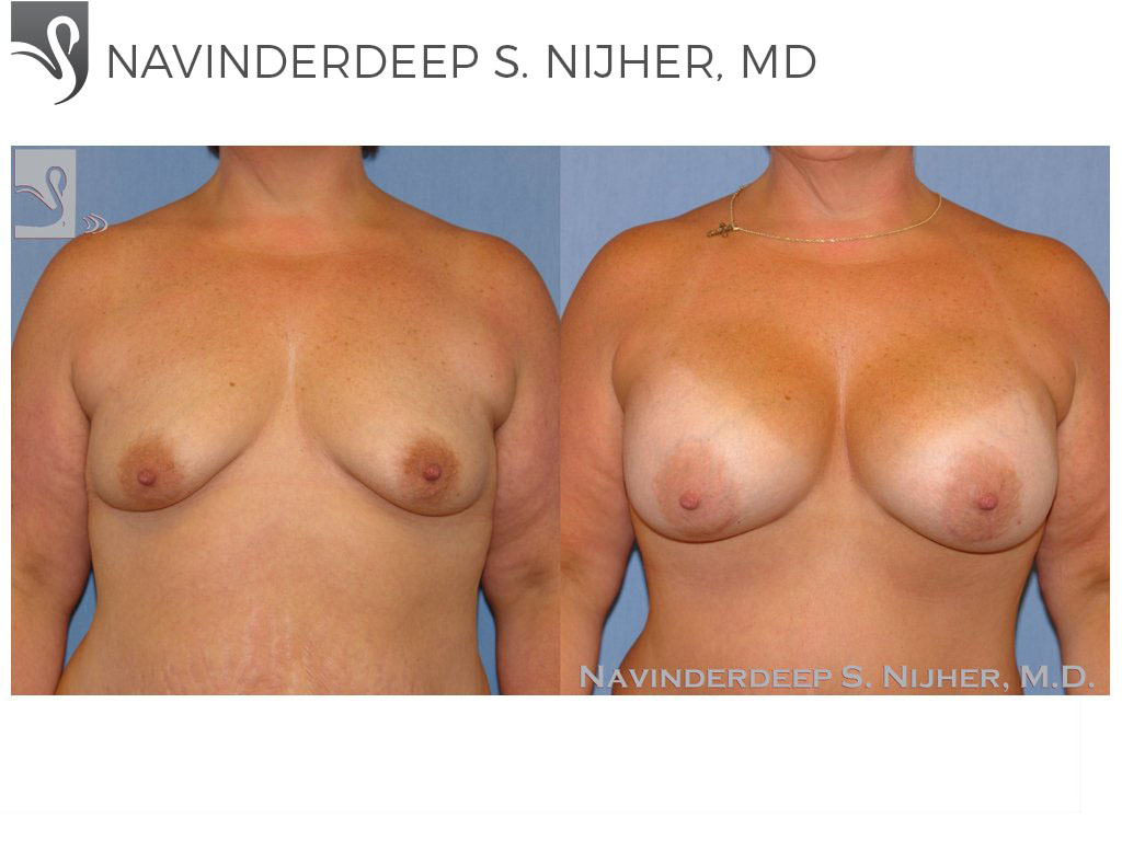 Before and After Image: Breast Augmentation Case #8987 - front