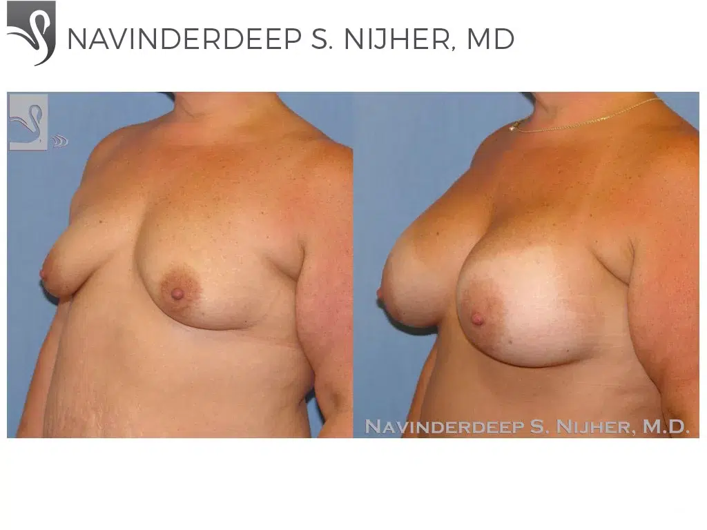 Before and After Image: Breast Augmentation Case #8987 - left-front-oblique