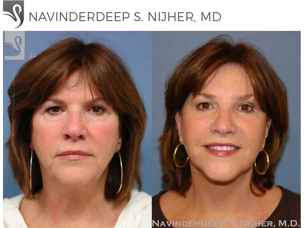 Before and After Image: Face Lift Case #1195 - front