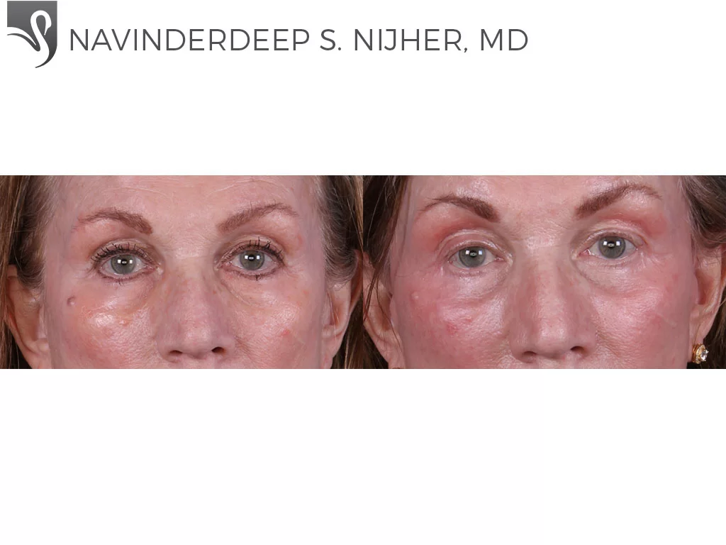 Before and After Image: Eyelid Surgery Case #13024 - front