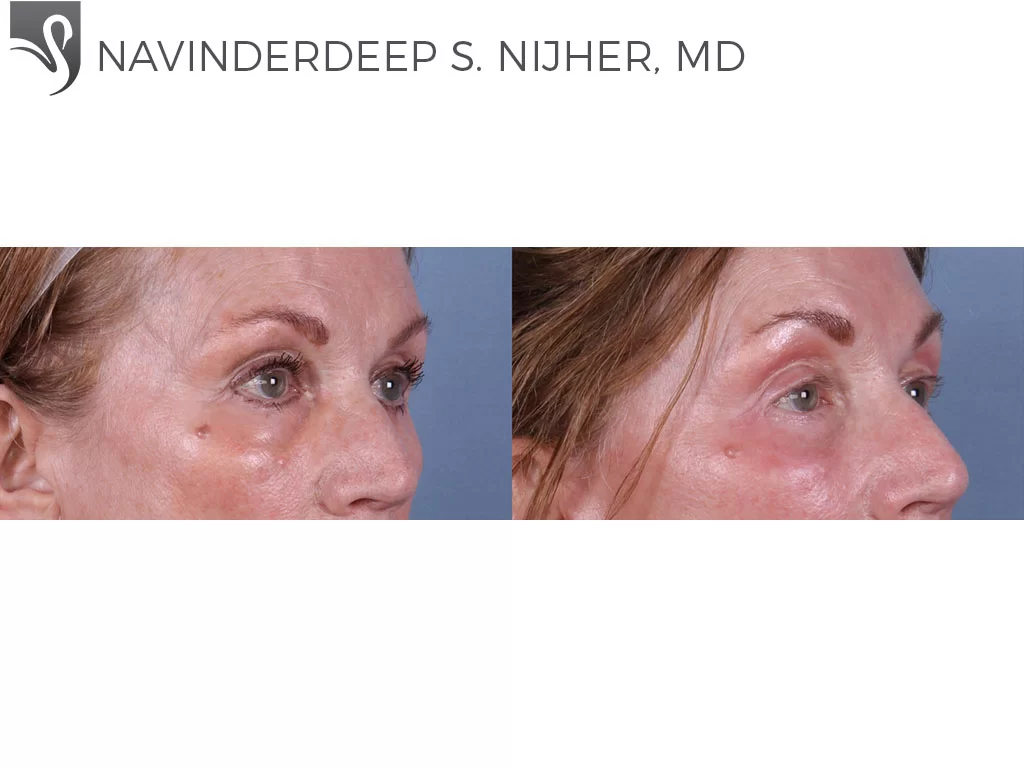 Before and After Image: Eyelid Surgery Case #13024 - right-front-oblique