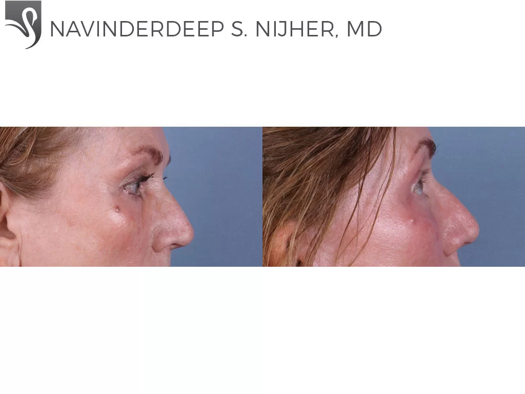Before and After Image: Eyelid Surgery Case #13024 - right-side