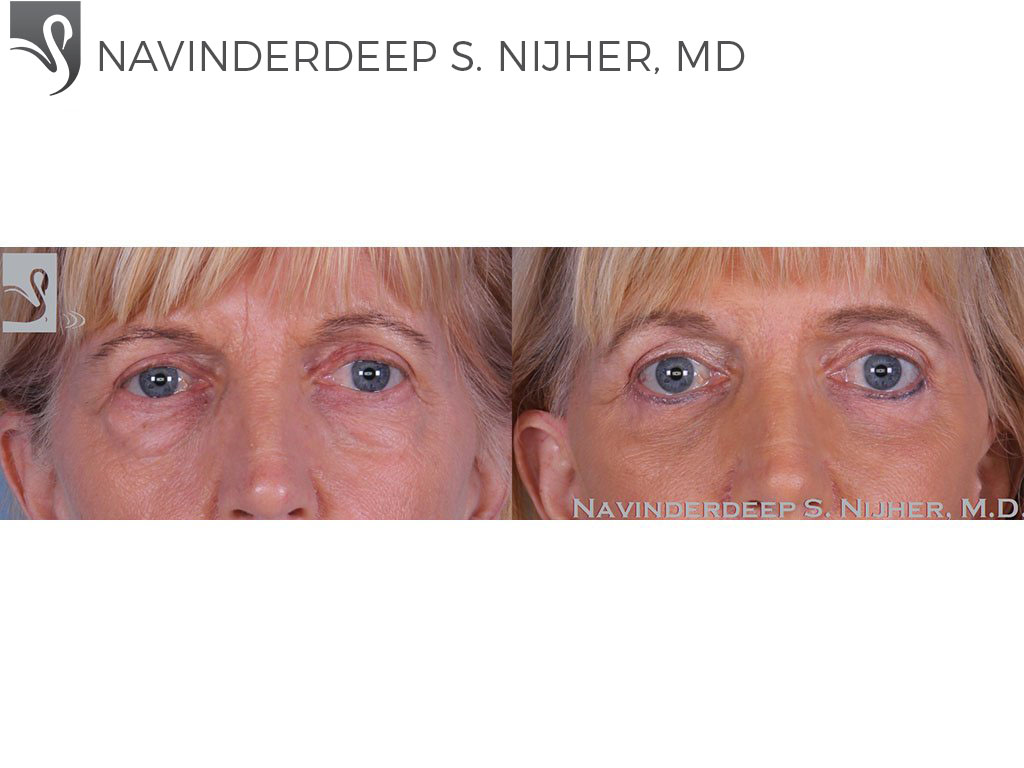 Before and After Image: Eyelid Surgery Case #13051 - front